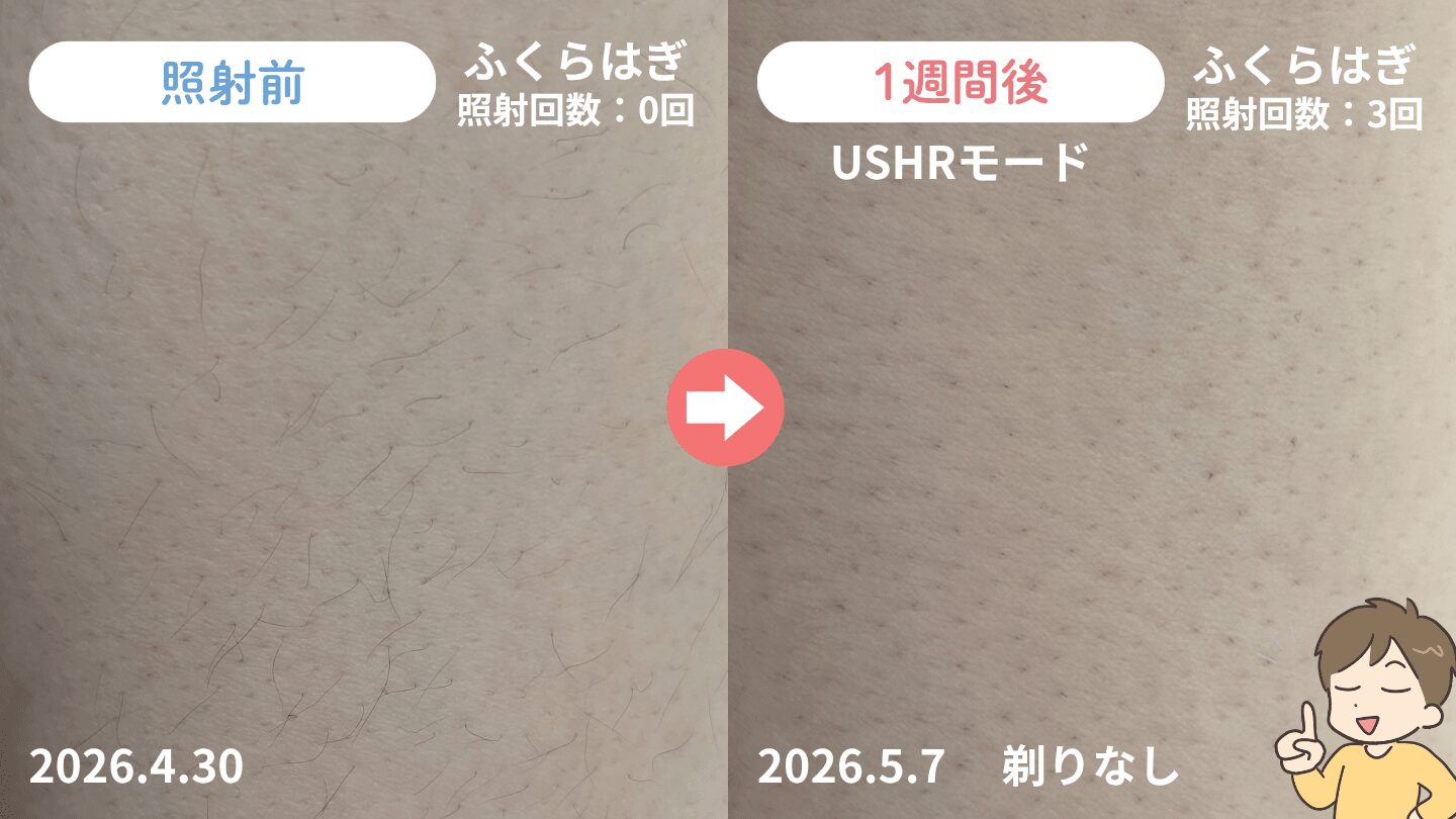 照射から1週間後のふくらはぎの毛の変化