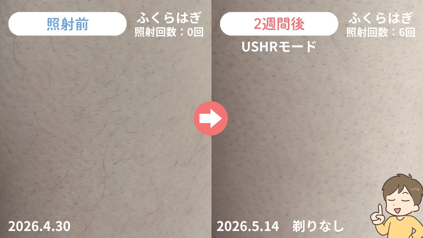2週間後のムダ毛の変化