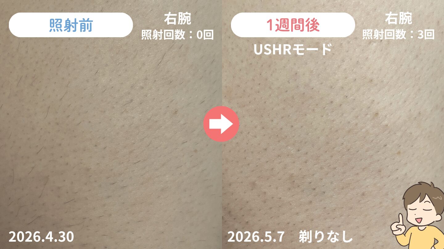 照射から1週間後の二の腕の毛の変化