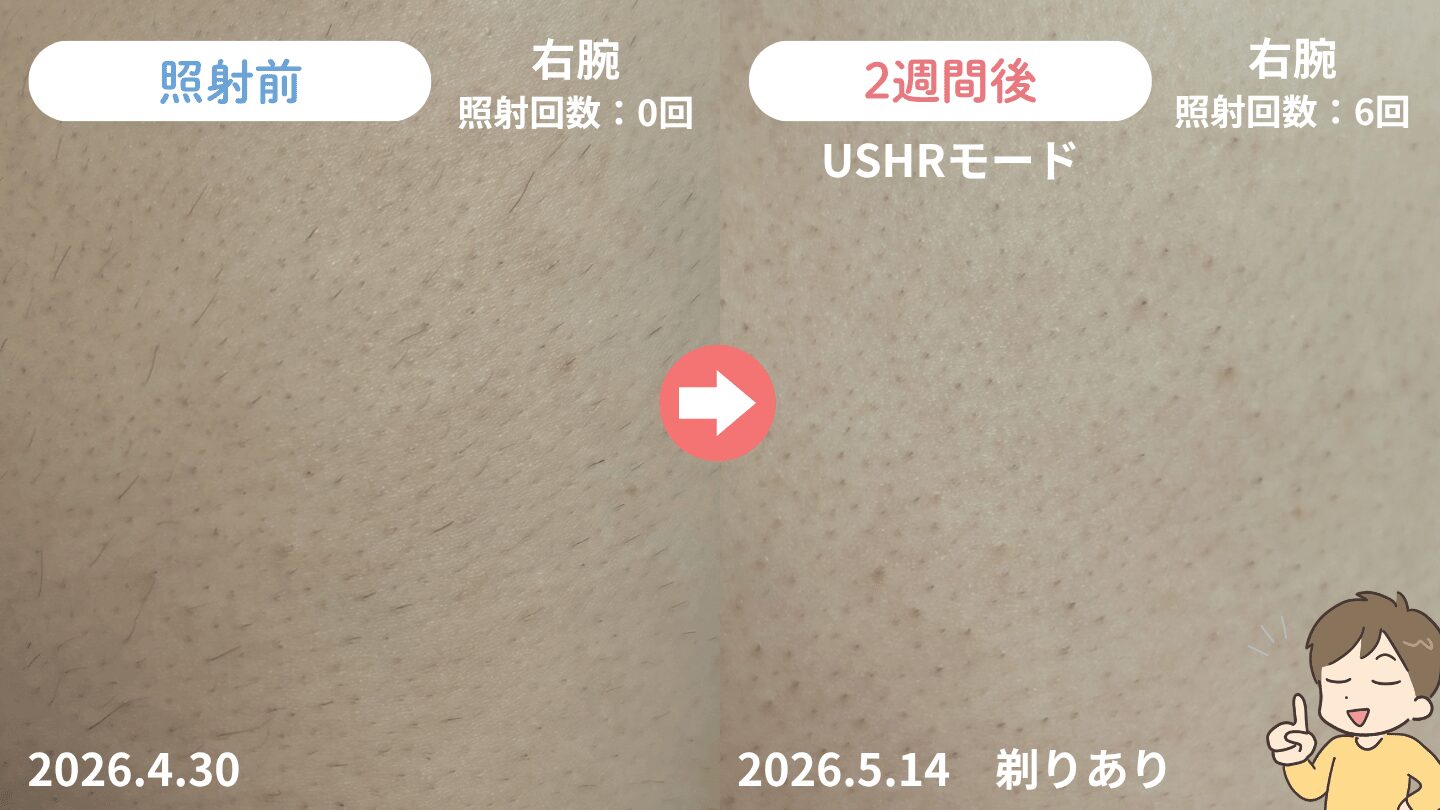 照射から2週間後の二の腕の毛の変化