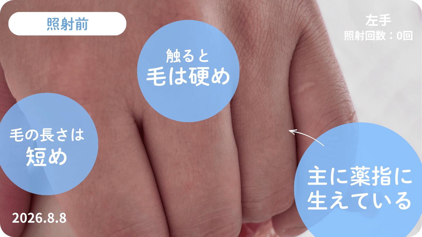 使用前の指毛（男性）