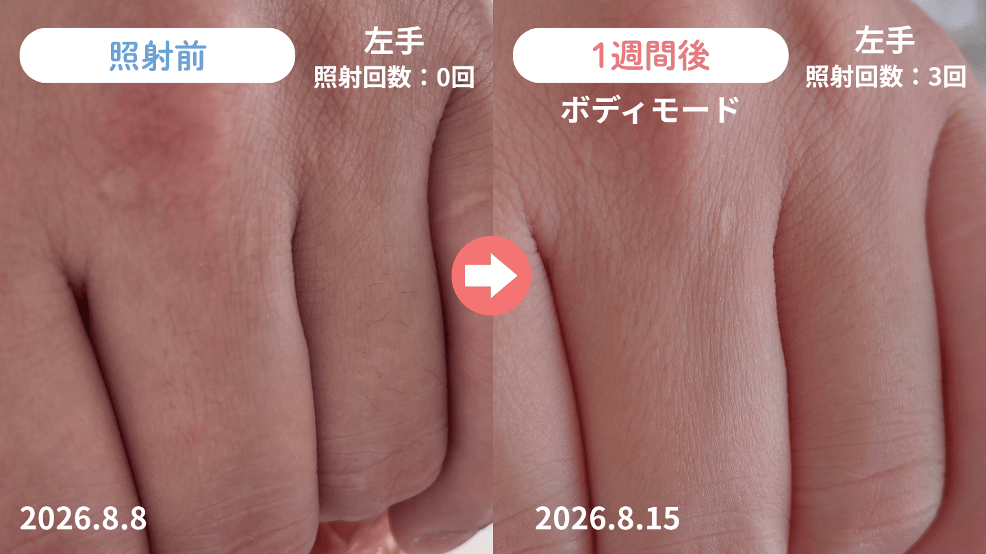 1週間（3回）使った指毛の変化