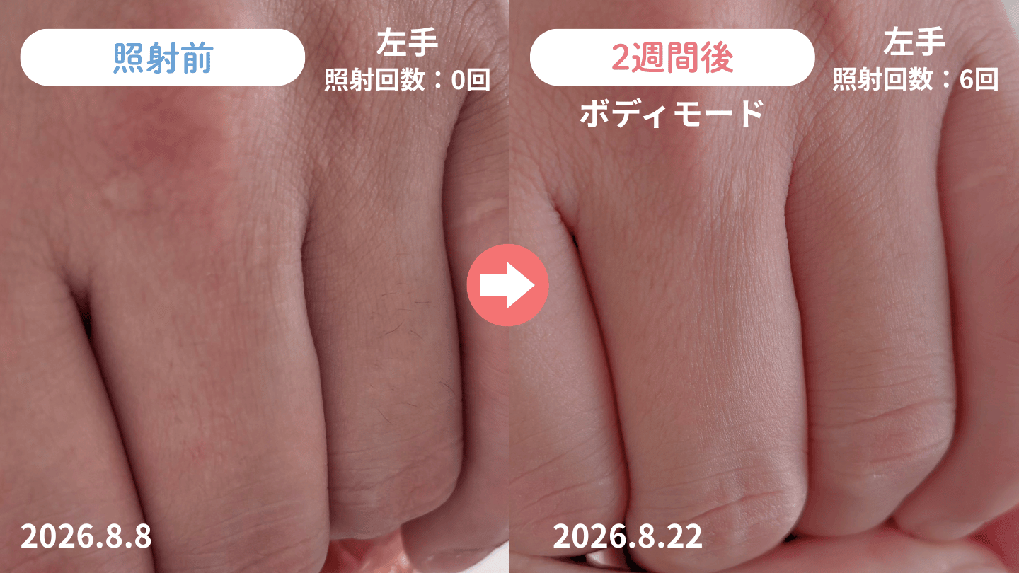 2週間（6回）使った指毛の変化